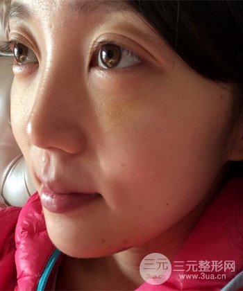 深圳內(nèi)切去眼袋+硅膠墊下巴真實(shí)案例恢復(fù)果圖
