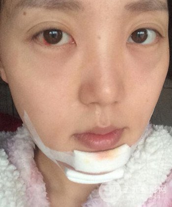 深圳內(nèi)切去眼袋+硅膠墊下巴真實(shí)案例恢復(fù)果圖