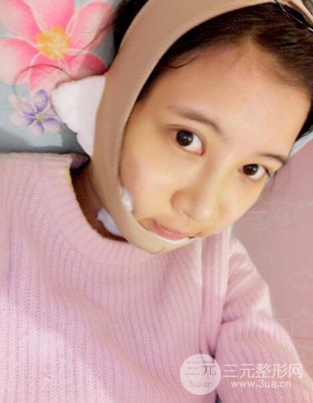 北京吸脂瘦臉真人案例恢復(fù)過程分享,巴掌小臉不是夢(mèng)