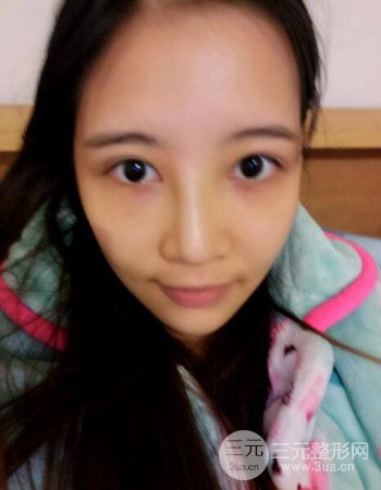 北京吸脂瘦臉真人案例恢復(fù)過程分享,巴掌小臉不是夢(mèng)