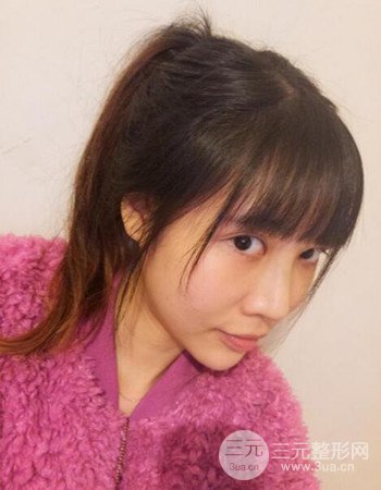 北京吸脂瘦臉真人案例恢復(fù)過程分享,巴掌小臉不是夢(mèng)