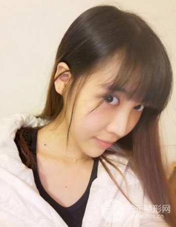 北京吸脂瘦臉真人案例恢復(fù)過程分享,巴掌小臉不是夢(mèng)