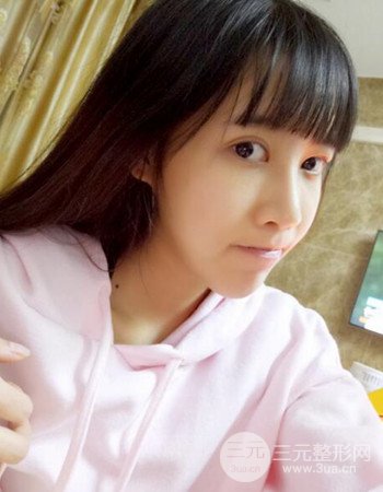 北京吸脂瘦臉真人案例恢復(fù)過程分享,巴掌小臉不是夢(mèng)