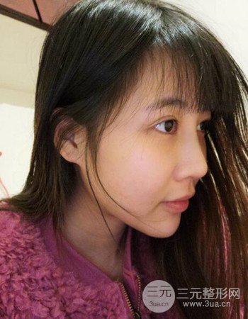 北京吸脂瘦臉真人案例恢復(fù)過程分享,巴掌小臉不是夢(mèng)