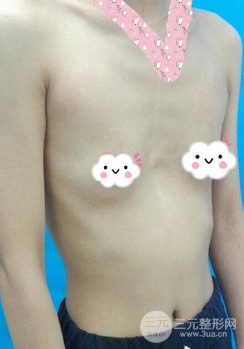 深圳假體隆胸讓平胸妹華麗變身,手術果分享