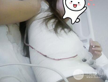 深圳假體隆胸讓平胸妹華麗變身,手術果分享