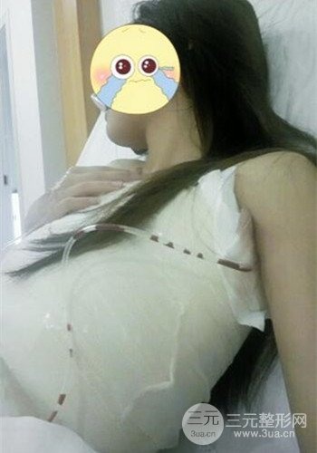 深圳假體隆胸讓平胸妹華麗變身,手術果分享