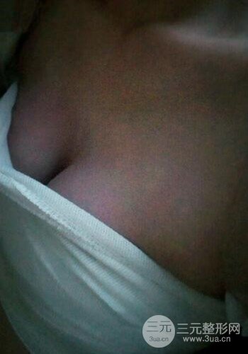 深圳假體隆胸讓平胸妹華麗變身,手術果分享