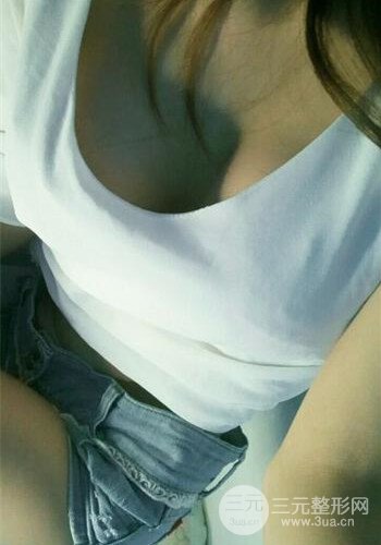 深圳假體隆胸讓平胸妹華麗變身,手術果分享