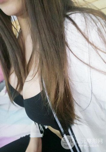 深圳假體隆胸讓平胸妹華麗變身,手術果分享