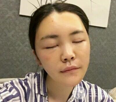 主播在深圳美臣做了自體脂肪全臉填充手術(shù)日記分享