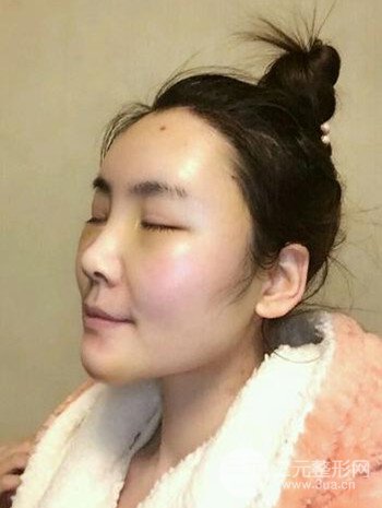 主播在深圳美臣做了自體脂肪全臉填充手術(shù)日記分享