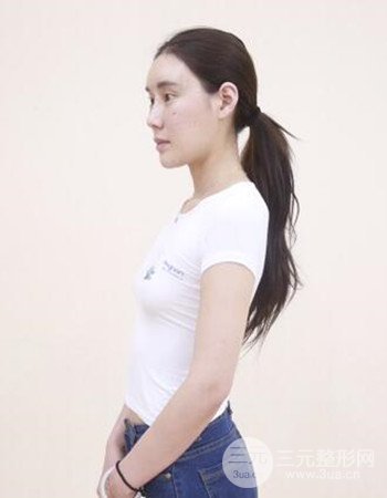 上海假體隆胸真人日記手術果分享，從A到D不是夢