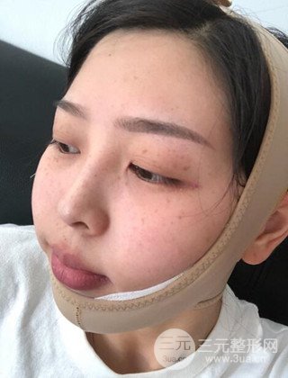 面部吸脂瘦臉手術(shù)日記分享,瘦臉果驚人