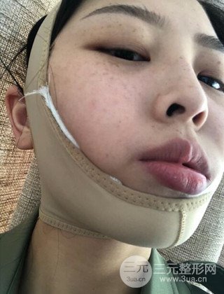 面部吸脂瘦臉手術(shù)日記分享,瘦臉果驚人