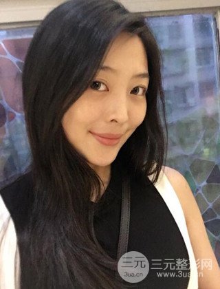 面部吸脂瘦臉手術(shù)日記分享,瘦臉果驚人