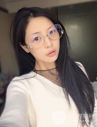 面部吸脂瘦臉手術(shù)日記分享,瘦臉果驚人