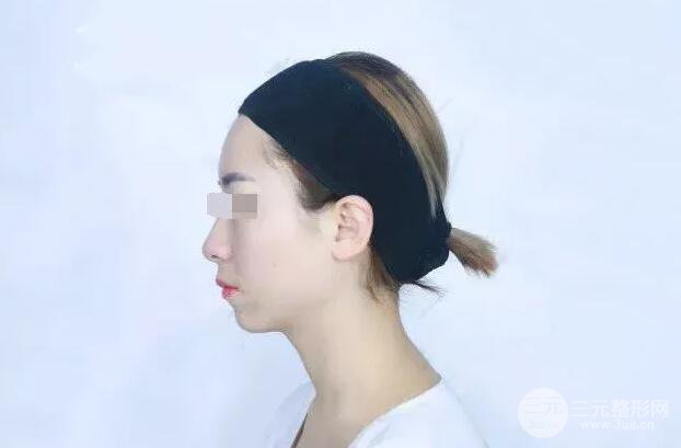 瑞蘭隆鼻多少錢 瑞蘭隆鼻真實(shí)一個(gè)月恢復(fù)前后對比圖案例