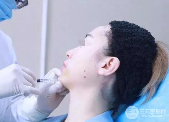 瑞蘭隆鼻多少錢 瑞蘭隆鼻真實(shí)一個(gè)月恢復(fù)前后對比圖案例