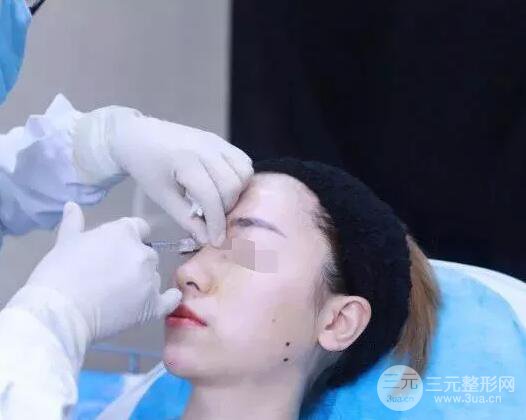 瑞蘭隆鼻多少錢 瑞蘭隆鼻真實(shí)一個(gè)月恢復(fù)前后對比圖案例