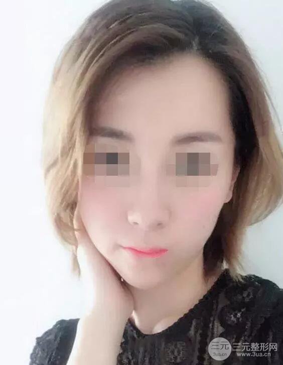 瑞蘭隆鼻多少錢 瑞蘭隆鼻真實(shí)一個(gè)月恢復(fù)前后對比圖案例