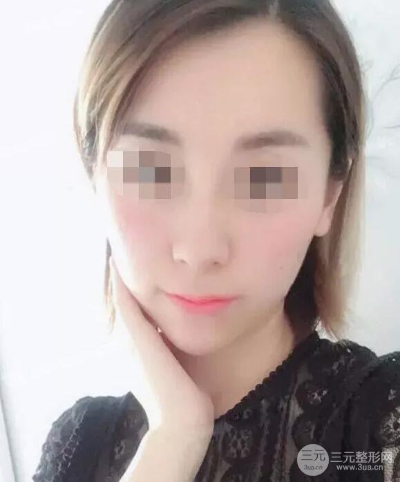 瑞蘭隆鼻多少錢 瑞蘭隆鼻真實(shí)一個(gè)月恢復(fù)前后對比圖案例