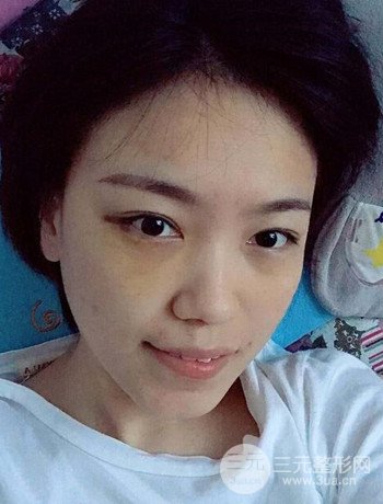 北京內(nèi)切祛眼袋真人案例果對比分享，年輕十歲不是夢