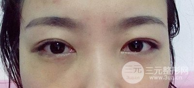 北京內(nèi)切祛眼袋真人案例果對比分享，年輕十歲不是夢