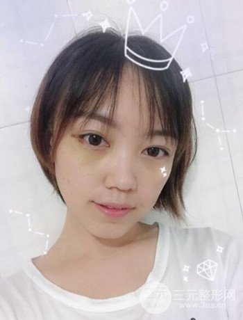 北京內(nèi)切祛眼袋真人案例果對比分享，年輕十歲不是夢