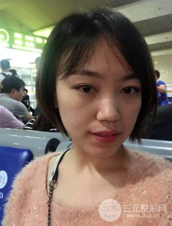 北京內(nèi)切祛眼袋真人案例果對比分享，年輕十歲不是夢