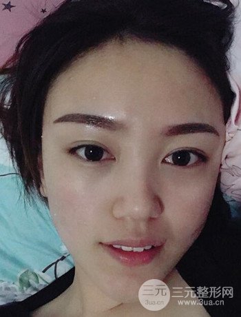 北京內(nèi)切祛眼袋真人案例果對比分享，年輕十歲不是夢