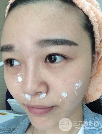 北京激光去雀斑真實(shí)案例分享，純素顏無(wú)濾鏡果圖