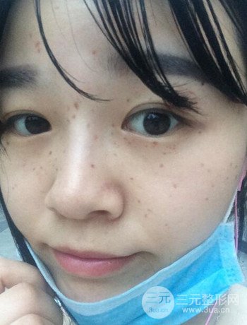 北京激光去雀斑真實(shí)案例分享，純素顏無(wú)濾鏡果圖