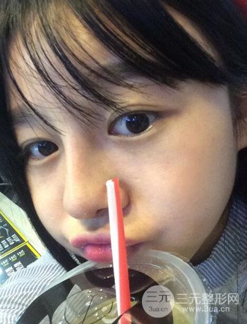 北京激光去雀斑真實(shí)案例分享，純素顏無(wú)濾鏡果圖