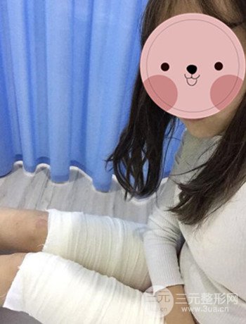 吸脂瘦大腿手術(shù)經(jīng)歷分享，纖細(xì)雙腿不再是夢(mèng)