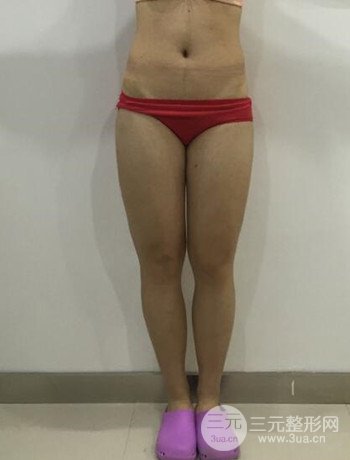 吸脂瘦大腿手術(shù)經(jīng)歷分享，纖細(xì)雙腿不再是夢(mèng)