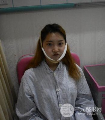 終于做了下頜角整形，分享術(shù)后恢復(fù)果