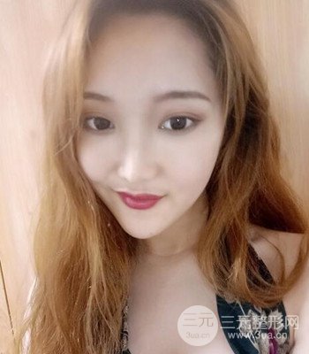 終于做了下頜角整形，分享術(shù)后恢復(fù)果