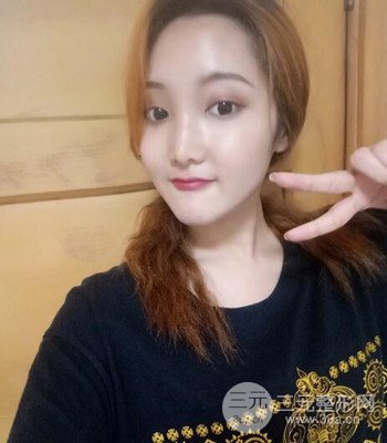 終于做了下頜角整形，分享術(shù)后恢復(fù)果