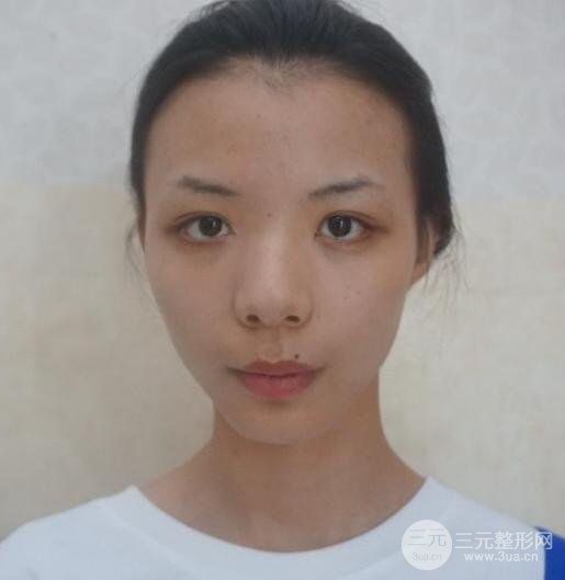 銀川崔大夫博士麗朱杰硅膠隆鼻恢復(fù)圖,輕松get精致臉
