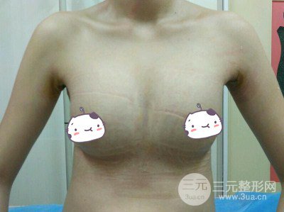 平胸妹做了假體隆胸果分享，豐滿(mǎn)身材不是夢(mèng)