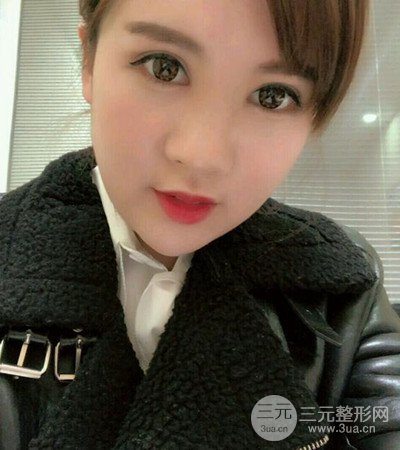 隆鼻整形手術(shù)個(gè)人經(jīng)歷分享,精致小翹鼻不是夢(mèng)