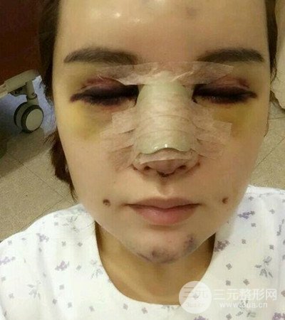 隆鼻整形手術(shù)個(gè)人經(jīng)歷分享,精致小翹鼻不是夢(mèng)