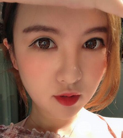 隆鼻整形手術(shù)個(gè)人經(jīng)歷分享,精致小翹鼻不是夢(mèng)