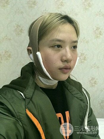 大圓臉做了面部吸脂瘦臉果很棒,立現(xiàn)漂亮鵝蛋臉