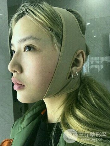 大圓臉做了面部吸脂瘦臉果很棒,立現(xiàn)漂亮鵝蛋臉