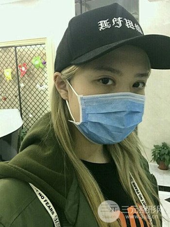 大圓臉做了面部吸脂瘦臉果很棒,立現(xiàn)漂亮鵝蛋臉