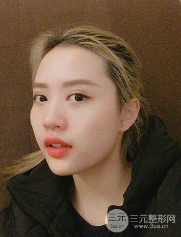 大圓臉做了面部吸脂瘦臉果很棒,立現(xiàn)漂亮鵝蛋臉