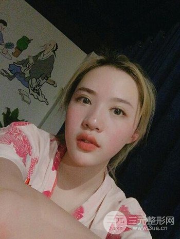 大圓臉做了面部吸脂瘦臉果很棒,立現(xiàn)漂亮鵝蛋臉