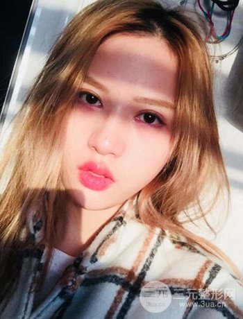 大圓臉做了面部吸脂瘦臉果很棒,立現(xiàn)漂亮鵝蛋臉